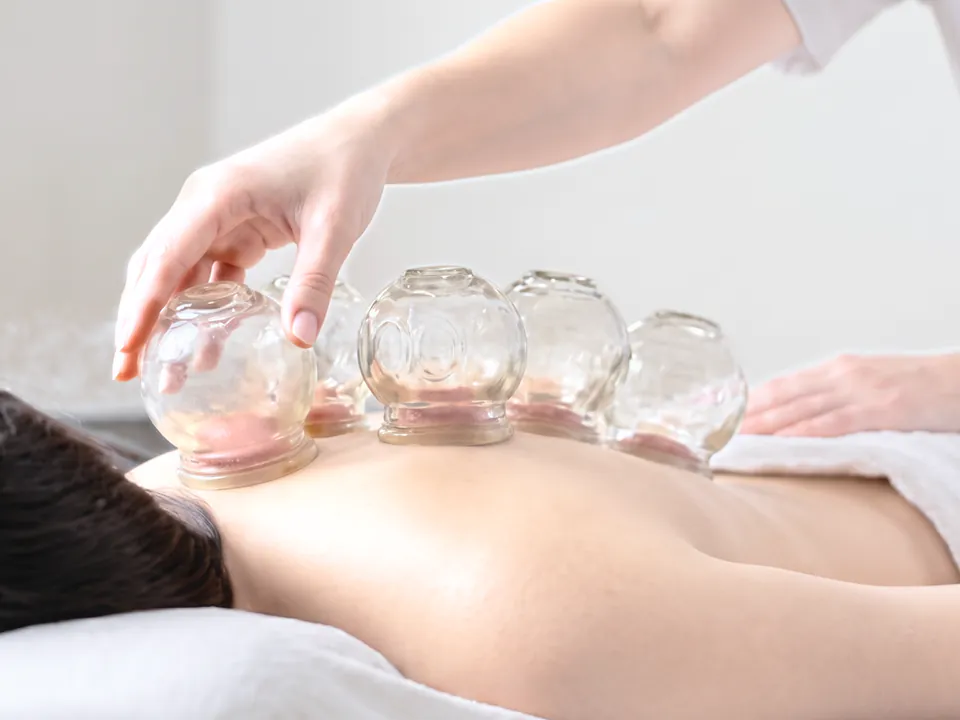 A ventosa cupping therapy